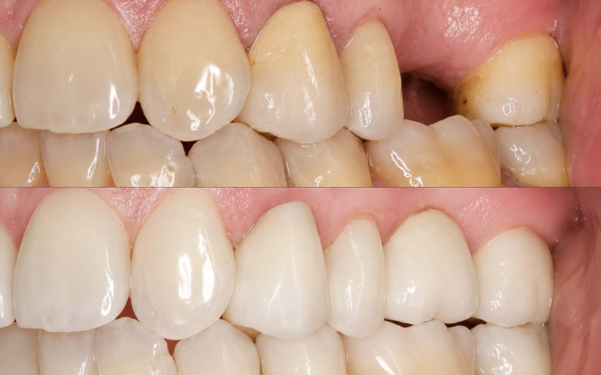antes y despues de ponerme implantes dentales | Tipos de implantes dentales cual es la mejor opcion para su salud oral antes y despues de ponerme implantes dentales | Tipos de implantes dentales cual es la mejor opcion para su salud oral