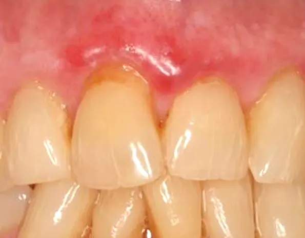 Liquen plano oral