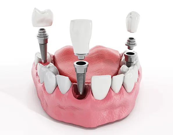 Rehabilitación protésica sobre implantes