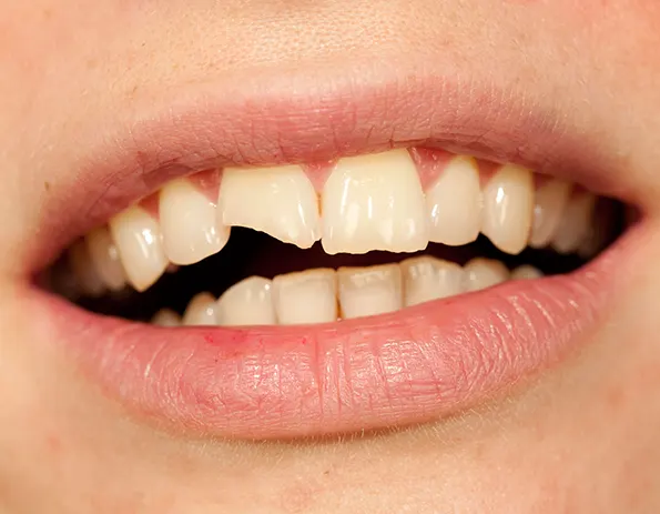 traumatismo dental