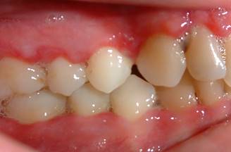 GUNA - Gingivitis ulcerocrotizante aguda