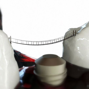 Los implantes dentales y la periimplantitis Los implantes dentales y la periimplantitis