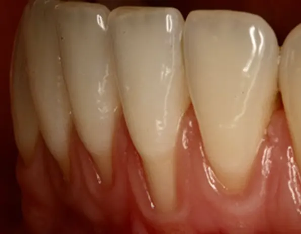 Recomendaciones para tratar pacientes con fenotipo periodontal fino (encía fina)