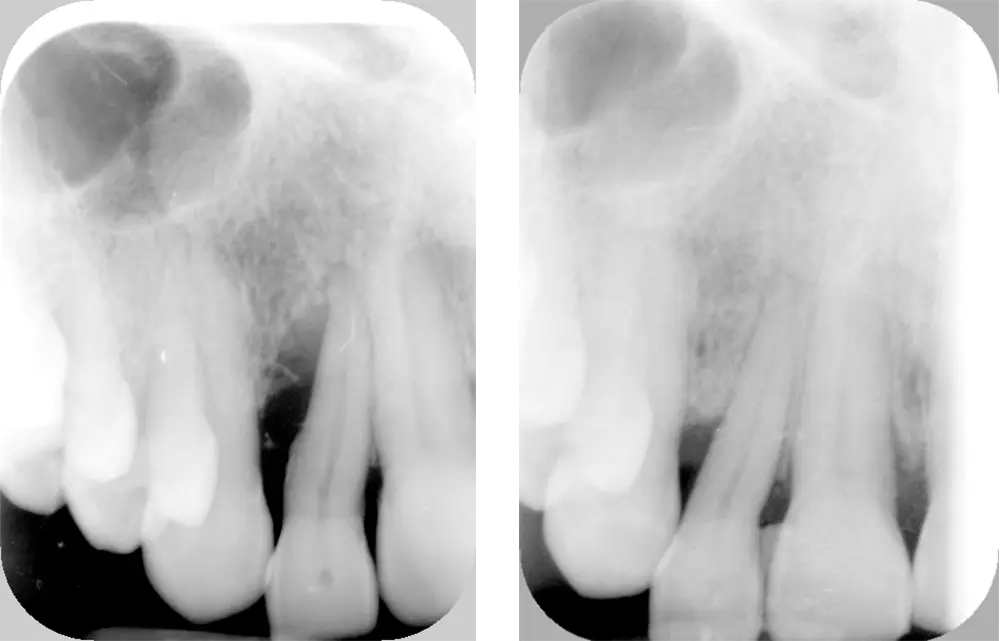 Tratamiento periodontal regenerativo Tratamiento periodontal regenerativo