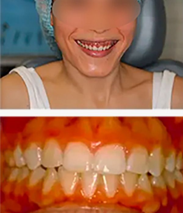 permitir las restauraciones dentales- paciente 2