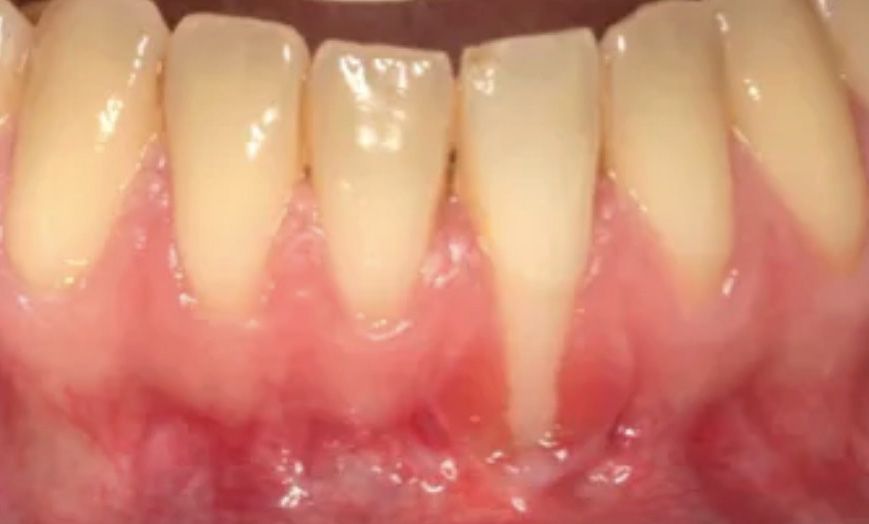 caso 5 injerto gingival antes