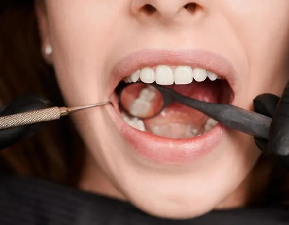 Todo lo que necesita saber para combatir la caries