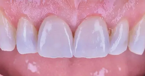 Carillas dentales - Clínica Vallcorba