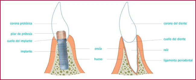 FAQS implantes dentales