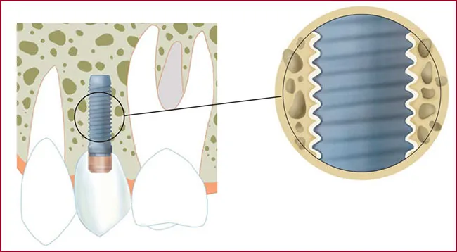 FAQS implantes dentales
