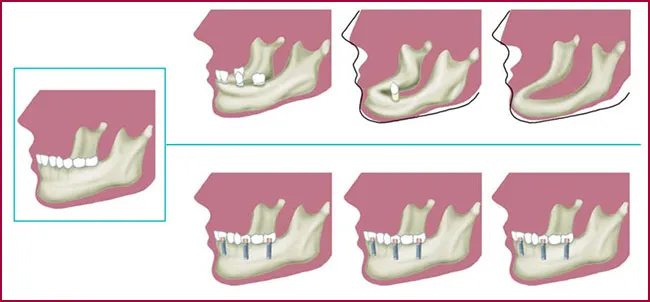 FAQS implantes dentales