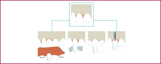 FAQS implantes dentales