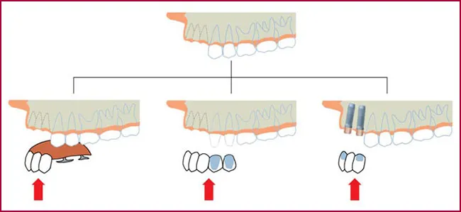 FAQS implantes dentales