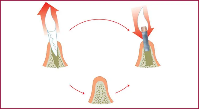 FAQS implantes dentales