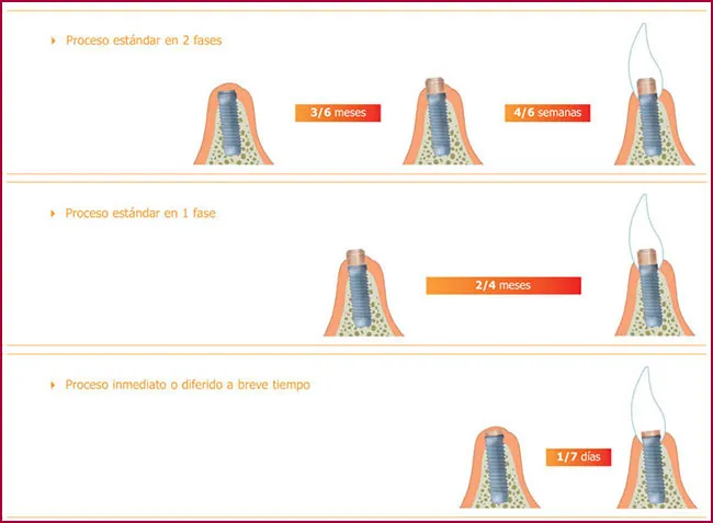 FAQS implantes dentales