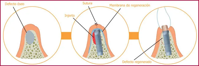 FAQS implantes dentales