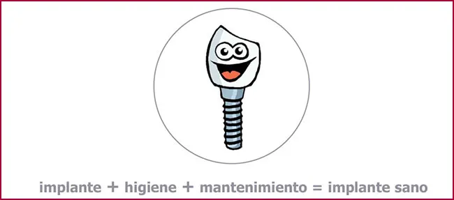 FAQS implantes dentales