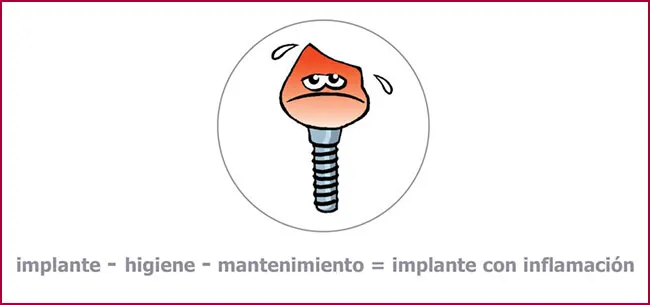 FAQS implantes dentales