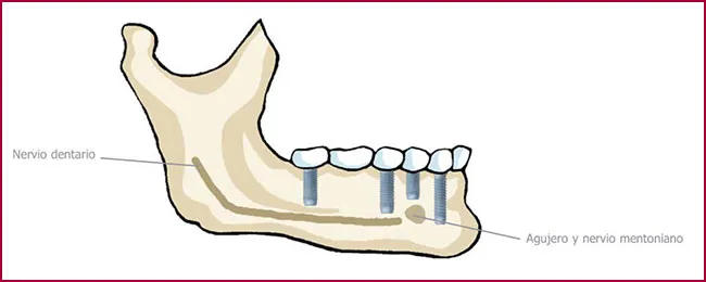 FAQS implantes dentales