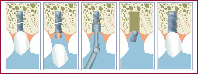 FAQS implantes dentales