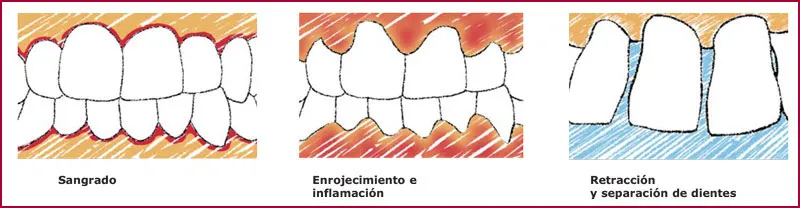 FAQS las encías