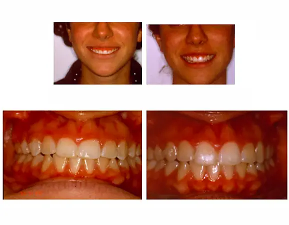 Gingivectomía, la cirugía de alargamiento de corona - Clínica Vallcorba