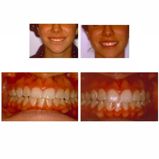 Gingivectomía, la cirugía de alargamiento de corona - Clínica Vallcorba