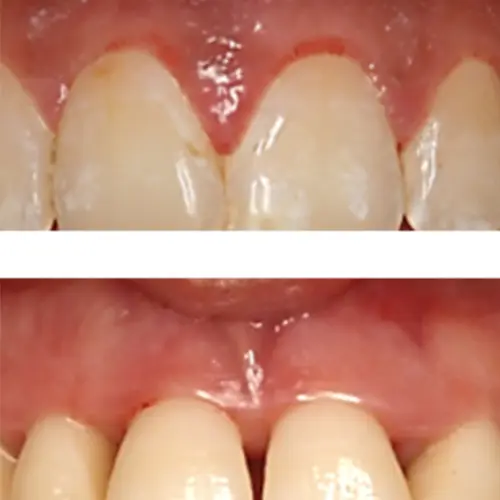 En que se diferencian las gingivitis y las periodontitis | Vallcorba En que se diferencian las gingivitis y las periodontitis | Vallcorba