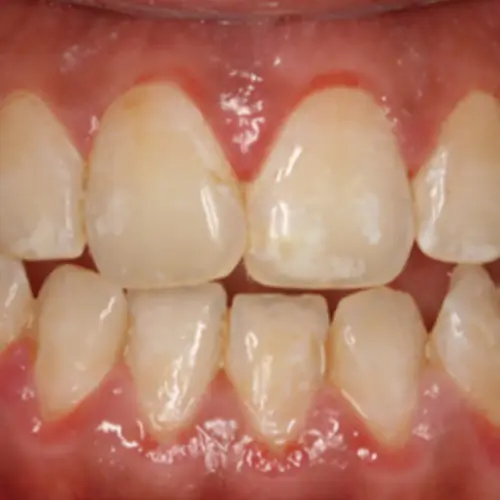 En que se diferencian las gingivitis y las periodontitis | Vallcorba En que se diferencian las gingivitis y las periodontitis | Vallcorba