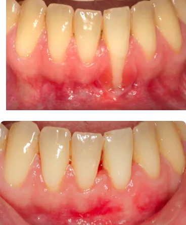 Empelt gingival a Clínica Vallcorba