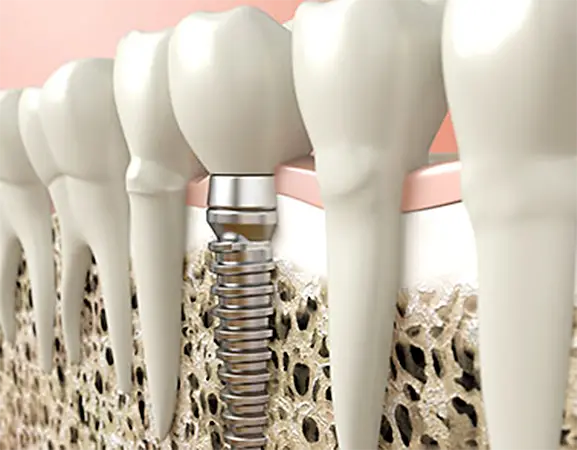 La importancia del control de los implantes dentales - Vallcorba