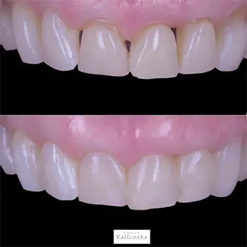 Mejorar la estética de la sonrisa | Clínica Vallcorba