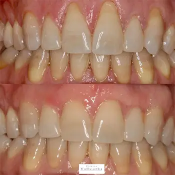 Mejorar la estética de la sonrisa | Clínica Vallcorba Mejorar la estética de la sonrisa | Clínica Vallcorba