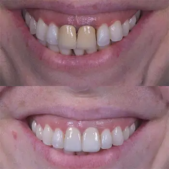 Mejorar la estética de la sonrisa | Clínica Vallcorba