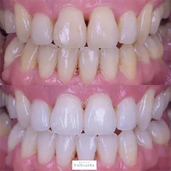 Mejorar la estética de la sonrisa | Clínica Vallcorba Mejorar la estética de la sonrisa | Clínica Vallcorba