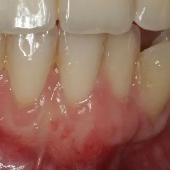 Microcirugía estética de las encías - Clínica Vallcorba