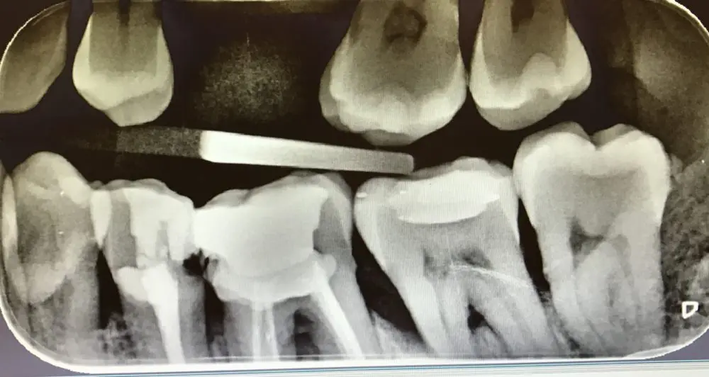 ¿Para qué realizamos radiografías los dentistas?