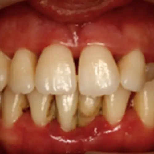 En que se diferencian las gingivitis y las periodontitis | Vallcorba