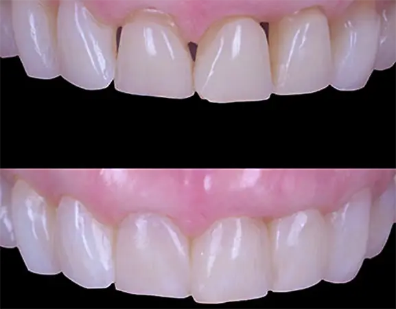¿Por qué me quedan triángulos negros entre los dientes? | Vallcorba
