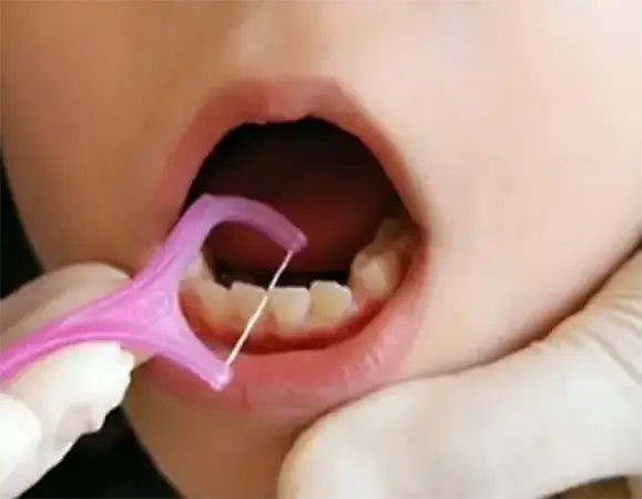 Tipos de hilo dental | Clínica Vallcorba