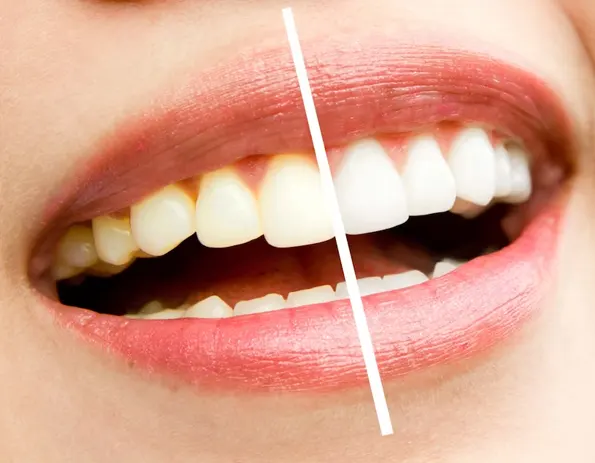 tratamiento blanqueador dental